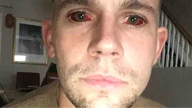 Man issues warning after five-day cocaine binge left him with ‘devil eyes’ and it almost killed him